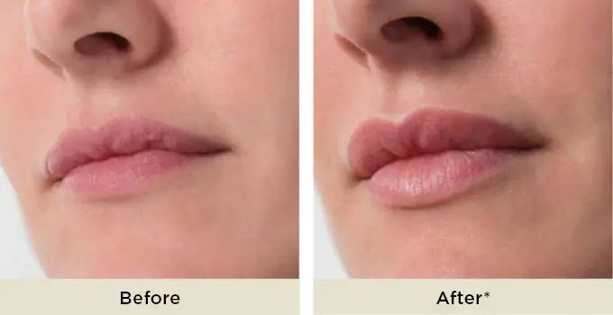 همه چیز درباره فیلر الیاکسین